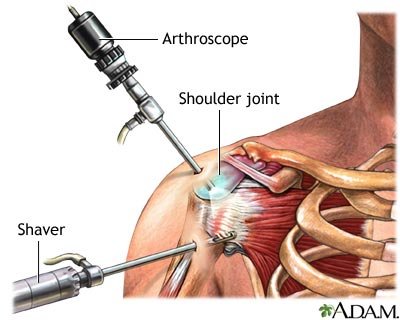 artroskopia_rameno_klinika_medicon.jpg